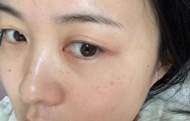 夏天脸特别爱出油怎么办 脸爱出油可以调理吗 夏天脸特别爱出油怎么办 脸爱出油可以调理吗