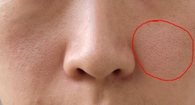 用a醇皮肤毛孔为什么会变大 泥膜可以收缩毛孔吗 用a醇皮肤毛孔为什么会变大 泥膜可以收缩毛孔吗