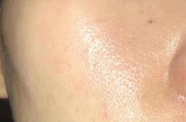 脸上一直出油怎么办 脸上冒痘跟出油有关系吗
