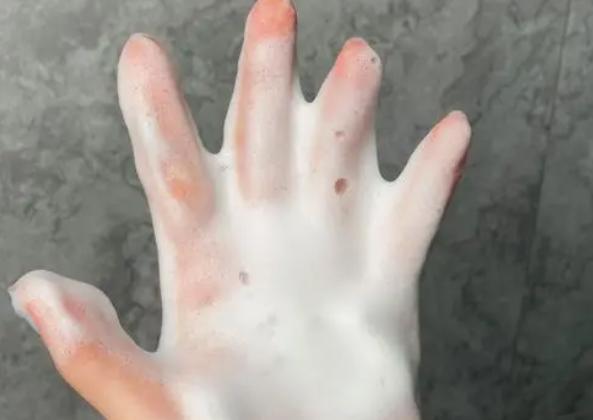 脸上头上出油特别多怎么回事 油性皮肤和脸特别爱出油有关系吗