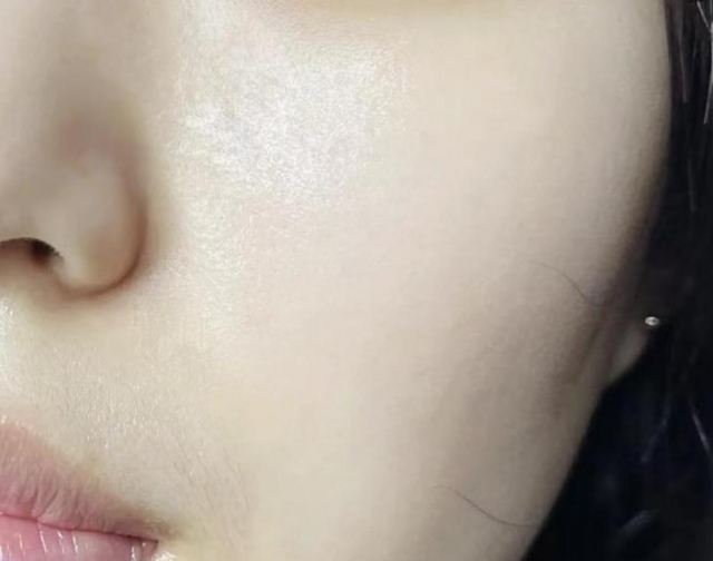 脸油头发油是湿气重吗 脸出油和脾胃有关系吗